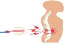 Bel fıtığı ameliyatından sonra tekrarlar mı? Nedenleri, Riskleri ve Tedavi Yaklaşımları Bel fıtığı ameliyatından sonra tekrarlar mı? Nedenleri, Riskleri ve Tedavi Yaklaşımları