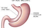 Tüp Mide Ameliyatı Nedir ve Neden Yapılır?