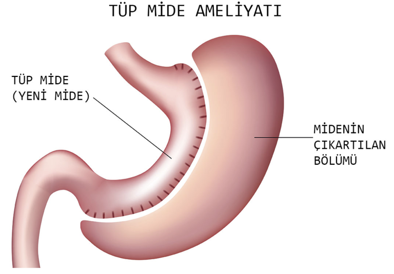 Tüp Mide Ameliyatı Nedir ve Neden Yapılır?