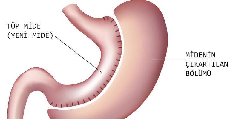 Tüp Mide Ameliyatı Nedir ve Neden Yapılır?