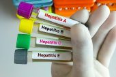 Hepatitte Aşılama Kronik Enfeksiyonları Önlemede %95 Etkili