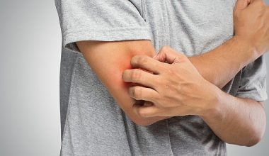 Mantar Hastalığı Hakkında Bilinmesi Gereken 6 Önemli Bilgi!