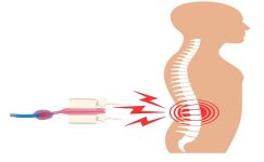 Bel fıtığı ameliyatından sonra tekrarlar mı? Nedenleri, Riskleri ve Tedavi Yaklaşımları