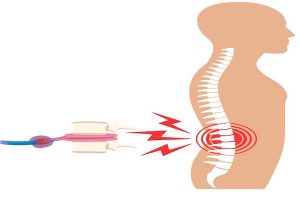 Bel fıtığı ameliyatından sonra tekrarlar mı? Nedenleri, Riskleri ve Tedavi Yaklaşımları