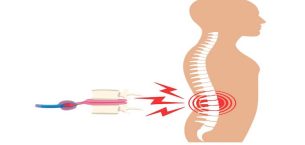 Bel fıtığı ameliyatından sonra tekrarlar mı? Nedenleri, Riskleri ve Tedavi Yaklaşımları