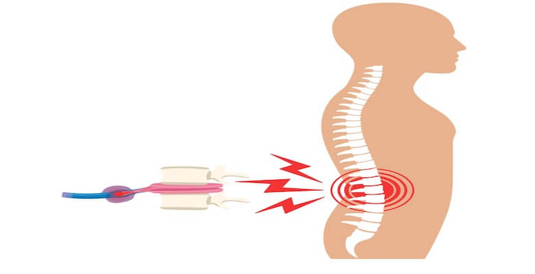 Bel fıtığı ameliyatından sonra tekrarlar mı? Nedenleri, Riskleri ve Tedavi Yaklaşımları
