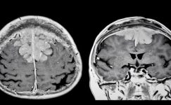 Beyin Tümörü Ameliyatı: Meningiomlar ve Güncel Tedavi Yaklaşımları