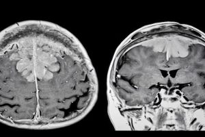 Beyin Tümörü Ameliyatı: Meningiomlar ve Güncel Tedavi Yaklaşımları