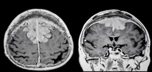 Beyin Tümörü Ameliyatı: Meningiomlar ve Güncel Tedavi Yaklaşımları