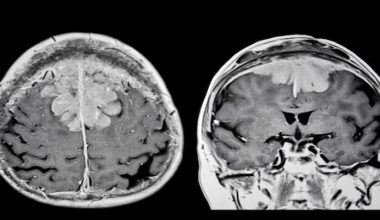 Beyin Tümörü Ameliyatı: Meningiomlar ve Güncel Tedavi Yaklaşımları