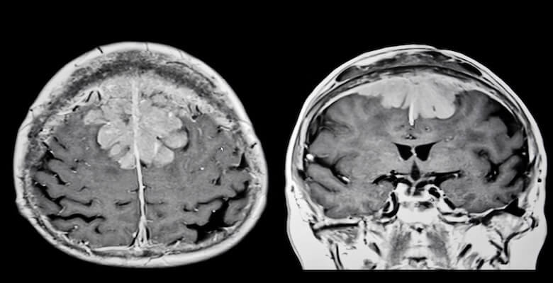 Beyin Tümörü Ameliyatı: Meningiomlar ve Güncel Tedavi Yaklaşımları