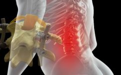 Platin Takılan Hastalar Nasıl Yaşar? Günlük Hayat, Hareket Kısıtlamaları ve Uzun Dönem Sonuçlar