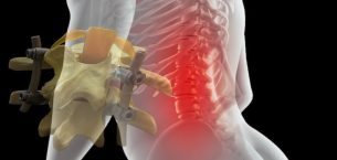 Platin Takılan Hastalar Nasıl Yaşar? Günlük Hayat, Hareket Kısıtlamaları ve Uzun Dönem Sonuçlar