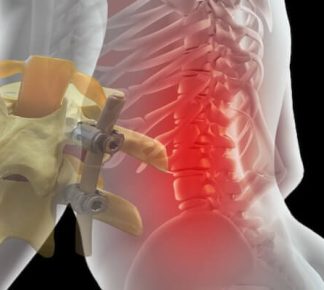 Platin Takılan Hastalar Nasıl Yaşar? Günlük Hayat, Hareket Kısıtlamaları ve Uzun Dönem Sonuçlar