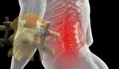 Platin Takılan Hastalar Nasıl Yaşar? Günlük Hayat, Hareket Kısıtlamaları ve Uzun Dönem Sonuçlar