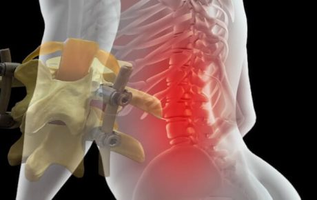 Platin Takılan Hastalar Nasıl Yaşar? Günlük Hayat, Hareket Kısıtlamaları ve Uzun Dönem Sonuçlar