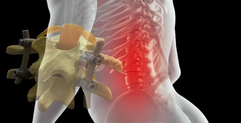 Platin Takılan Hastalar Nasıl Yaşar? Günlük Hayat, Hareket Kısıtlamaları ve Uzun Dönem Sonuçlar