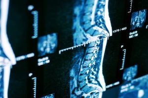 Omurga Sağlığının 5 Büyük Düşmanı: Bel Fıtığı Neden Oluşur?