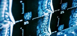 Omurga Sağlığının 5 Büyük Düşmanı: Bel Fıtığı Neden Oluşur?