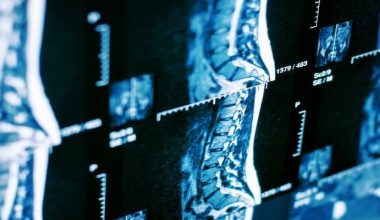 Omurga Sağlığının 5 Büyük Düşmanı: Bel Fıtığı Neden Oluşur?