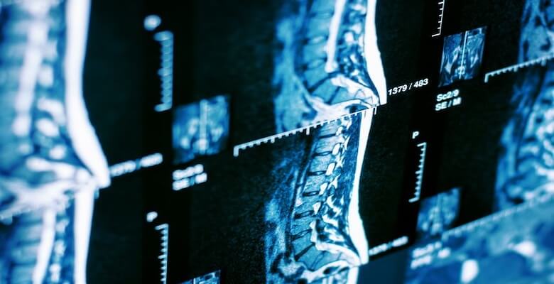 Omurga Sağlığının 5 Büyük Düşmanı: Bel Fıtığı Neden Oluşur?